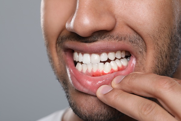 How A Periodontist Approaches Bleeding Gum Treatment
