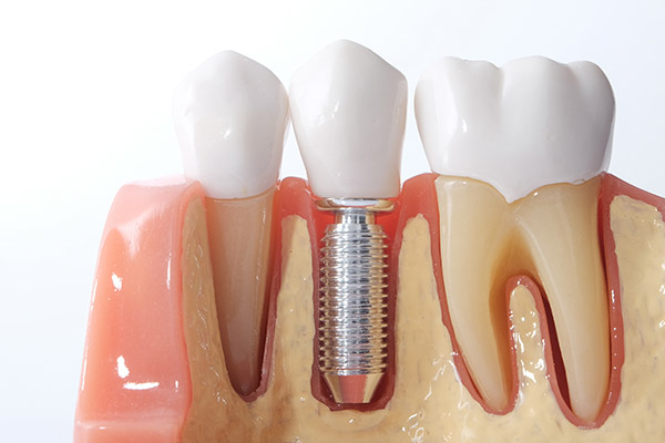 When Bone Grafting Is Recommended For Dental Implants