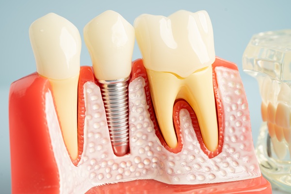 FAQs About Dental Implants