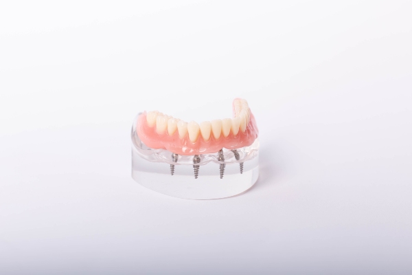Pros And Cons Of All On Dental Implants