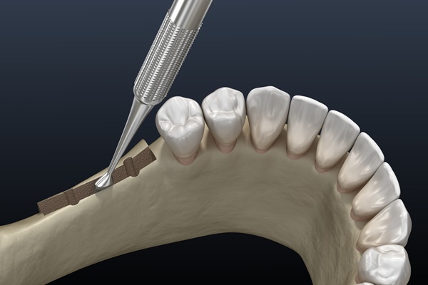 Facts Patients Need To Know About Ridge Augmentation From A Periodontist